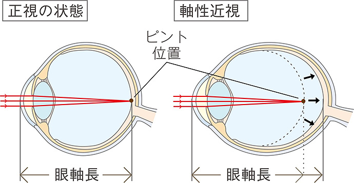 眼軸長