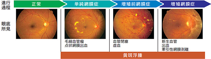 糖尿病網膜症