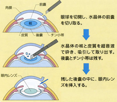 白内障手術